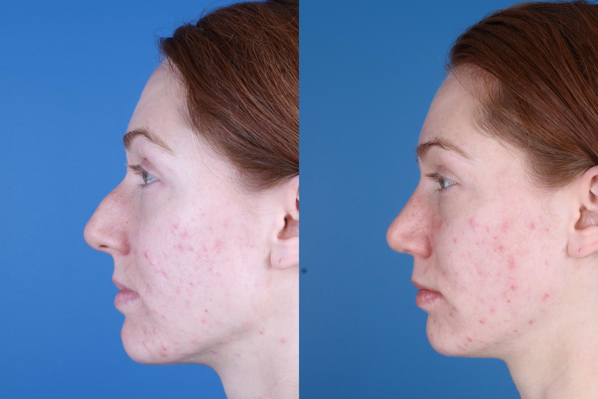 Raval Facial Aesthetics rhinoplasty result — Denver, CO