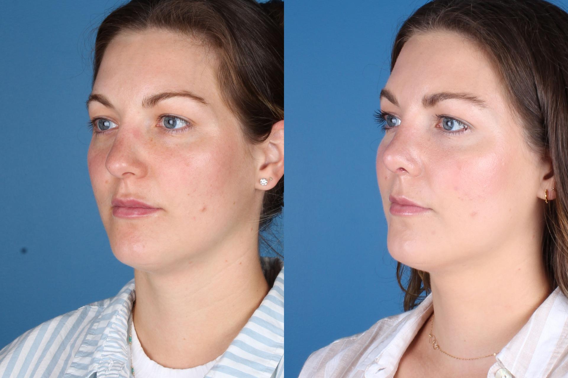 Raval Facial Aesthetics rhinoplasty result — Denver, CO