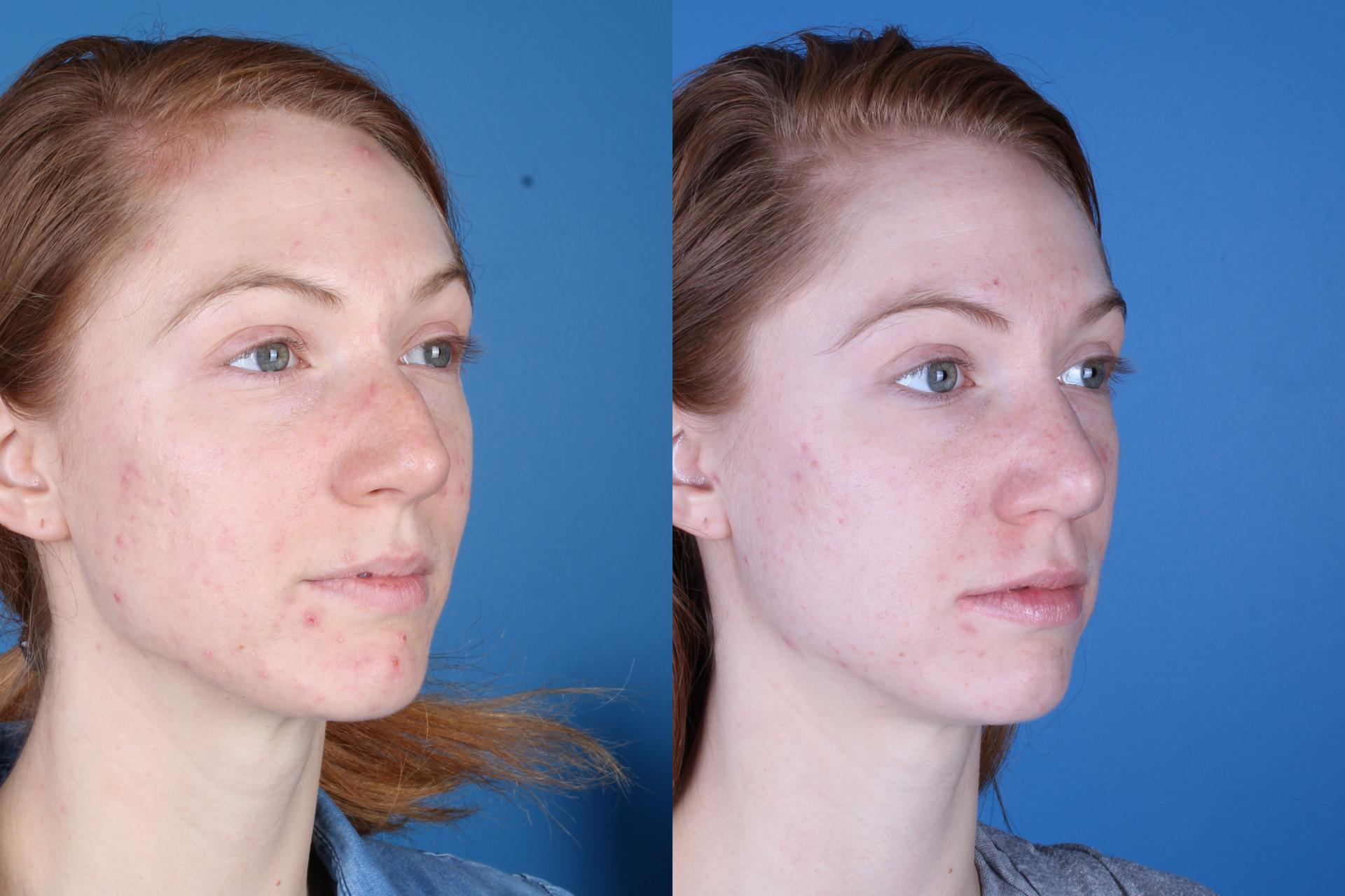 Raval Facial Aesthetics rhinoplasty result — Denver, CO