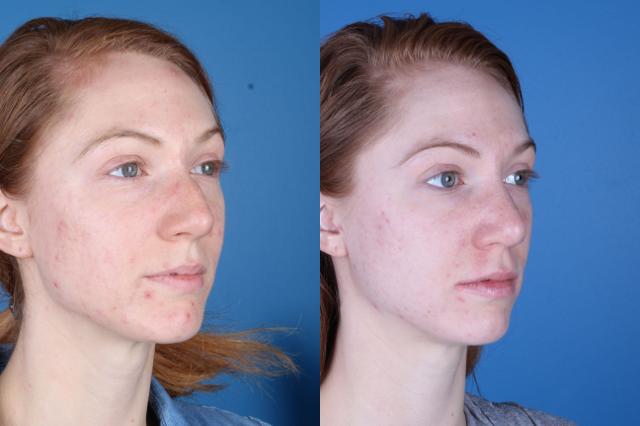 Functional Rhinoplasty result at Raval Facial Aesthetics in Denver, CO