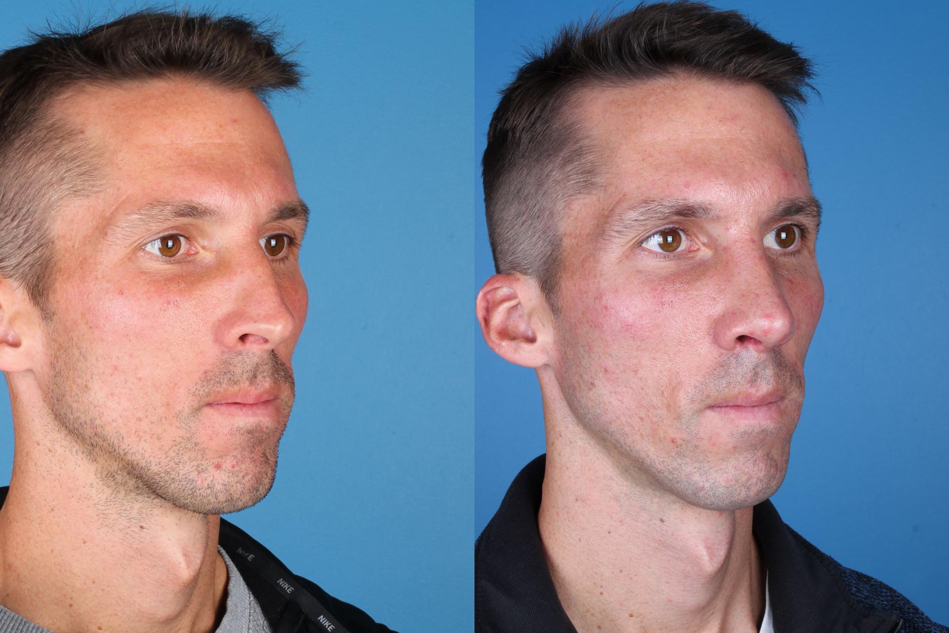 Raval Facial Aesthetics rhinoplasty result — Denver, CO