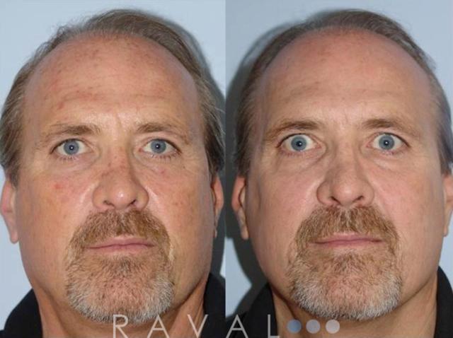 Laser Skin Resurfacing result at Raval Facial Aesthetics in Denver, CO