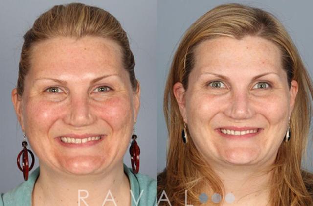 Laser Skin Resurfacing result at Raval Facial Aesthetics in Denver, CO