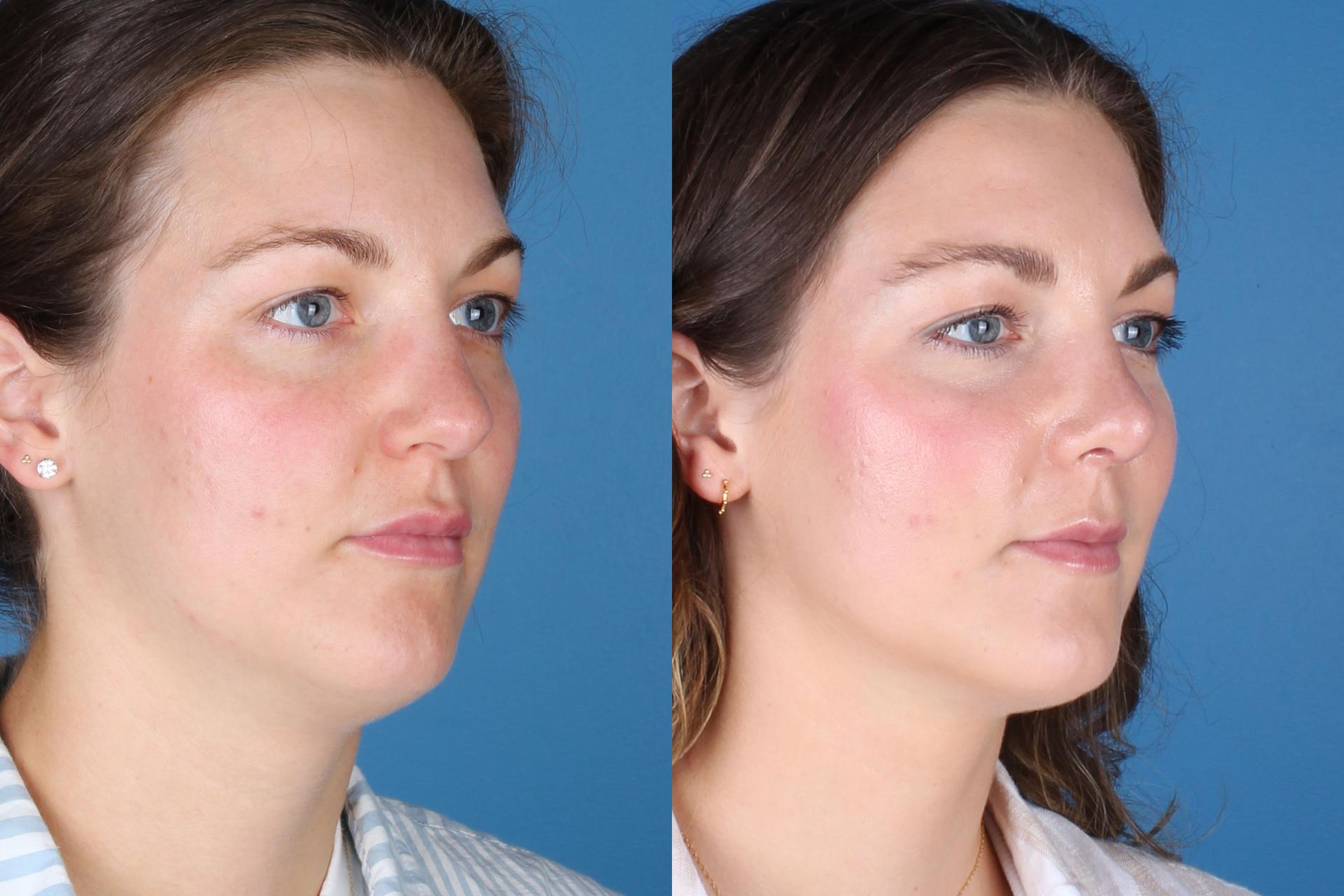 Raval Facial Aesthetics rhinoplasty result — Denver, CO
