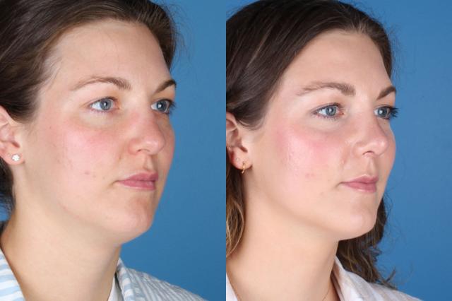 Functional Rhinoplasty result at Raval Facial Aesthetics in Denver, CO