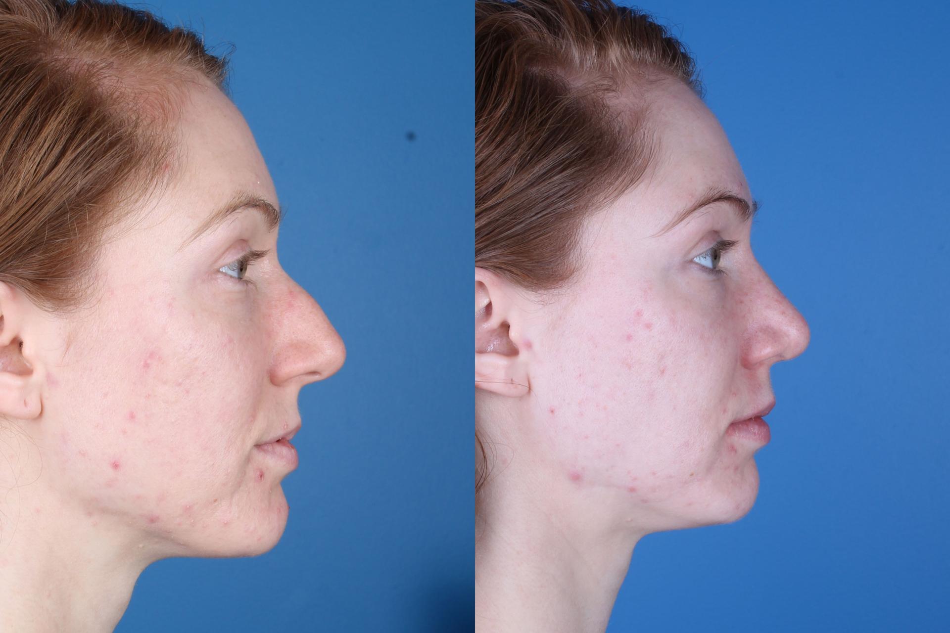 Raval Facial Aesthetics rhinoplasty result — Denver, CO