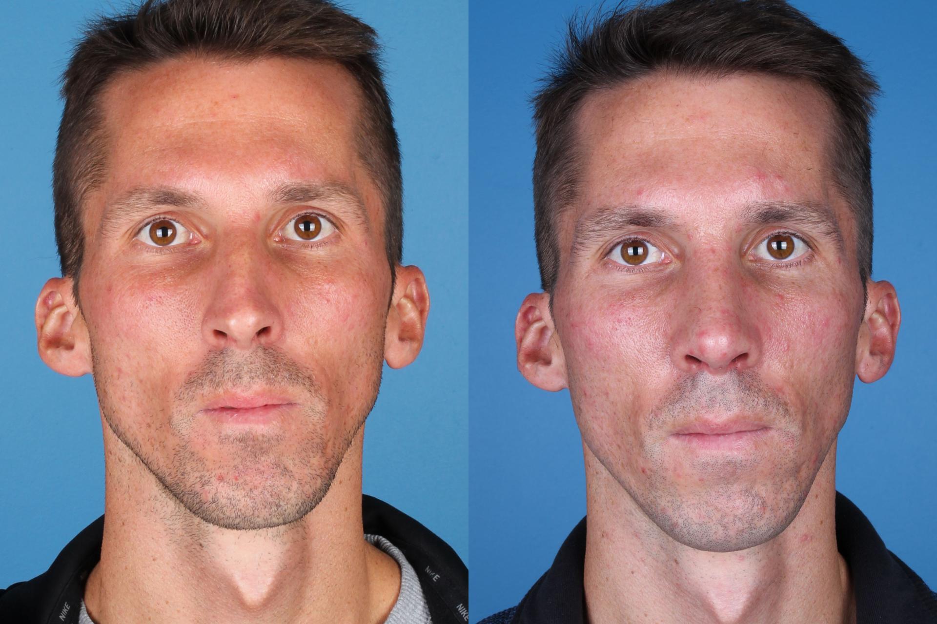 Raval Facial Aesthetics rhinoplasty result — Denver, CO