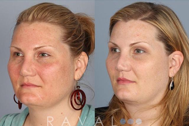 Laser Skin Resurfacing result at Raval Facial Aesthetics in Denver, CO