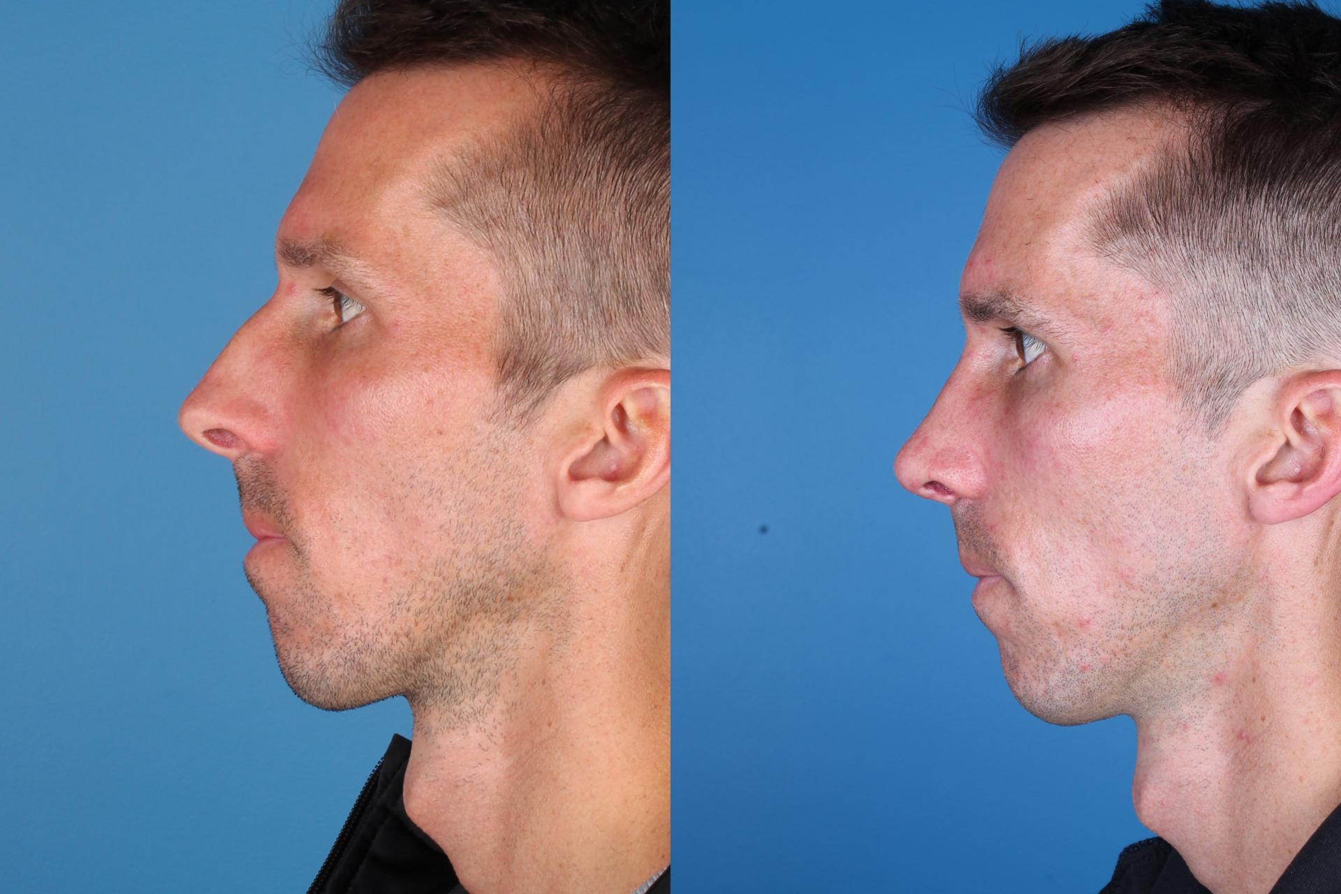 Raval Facial Aesthetics rhinoplasty result — Denver, CO