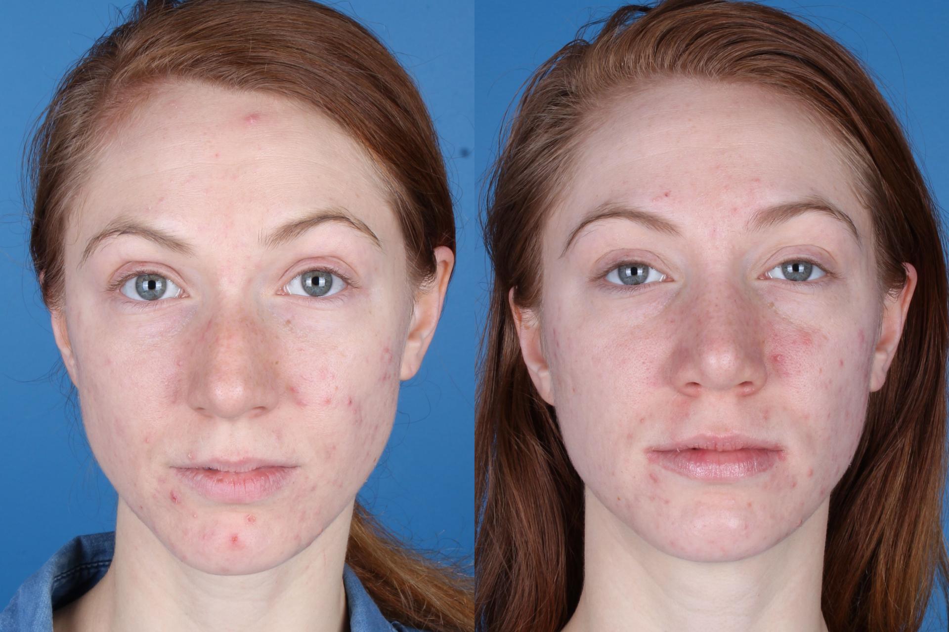 Raval Facial Aesthetics rhinoplasty result — Denver, CO