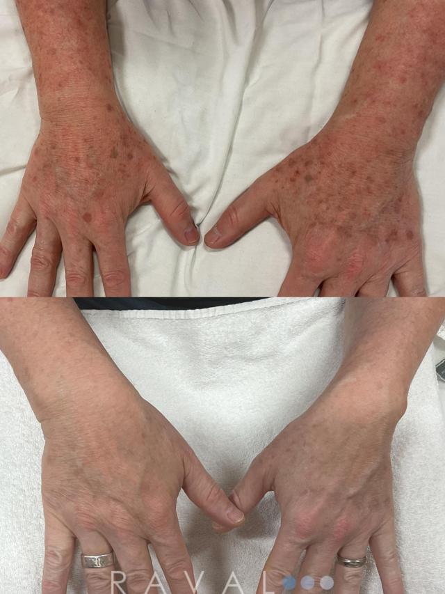 Laser Skin Resurfacing result at Raval Facial Aesthetics in Denver, CO