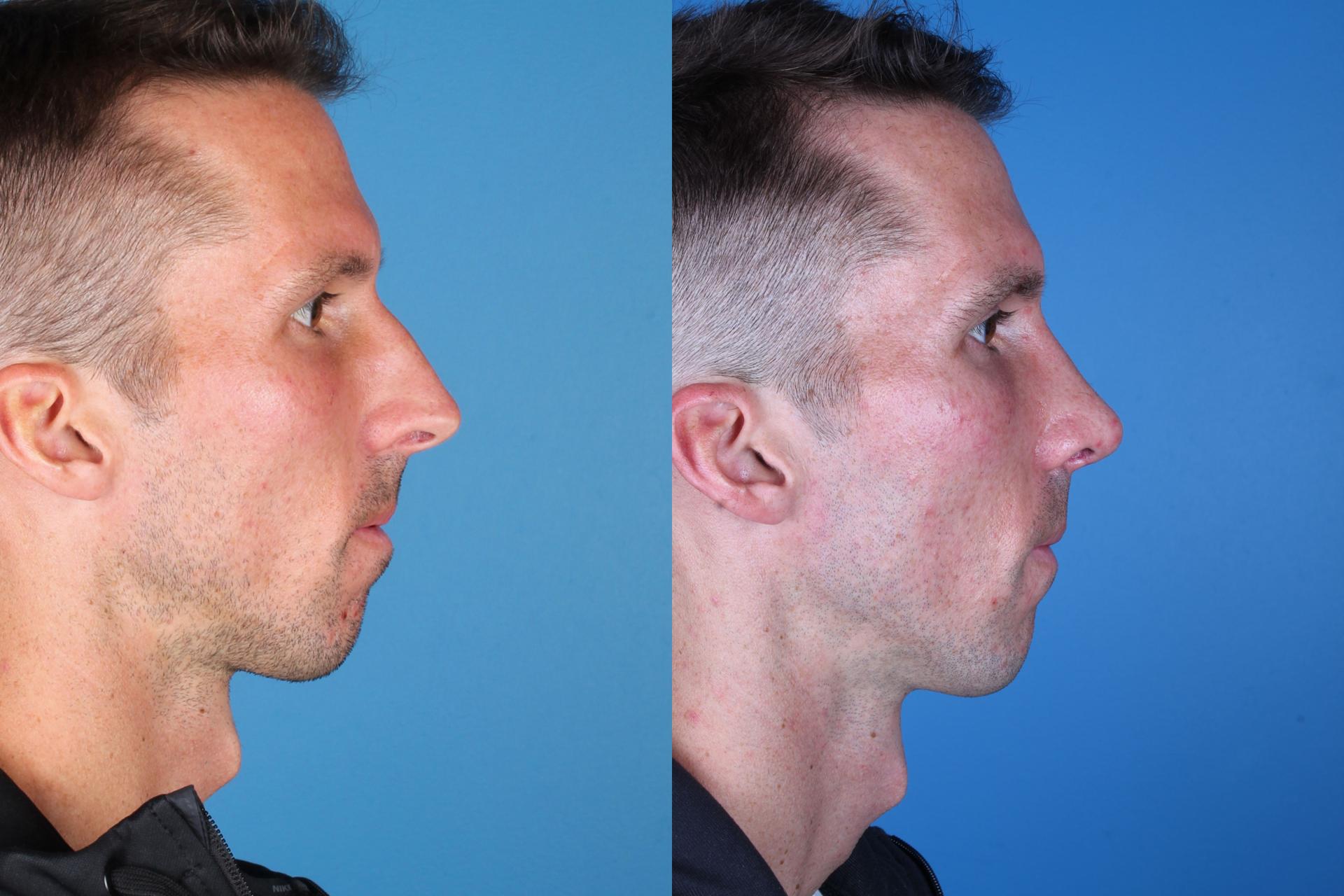 Raval Facial Aesthetics rhinoplasty result — Denver, CO