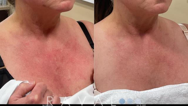 Laser Skin Resurfacing result at Raval Facial Aesthetics in Denver, CO