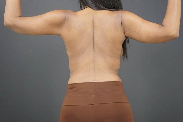 Arm Lift after at Élevé Plastic & Reconstructive Surgery (Olatomide (Tomi) Familusi, MD) in Atlanta, GA