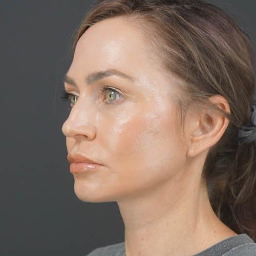 Élevé Plastic & Reconstructive Surgery (Olatomide (Tomi) Familusi, MD) facelift after — Atlanta, GA
