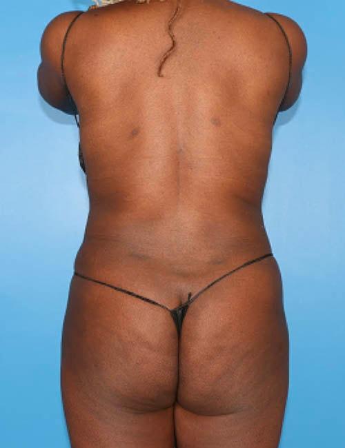 Élevé Plastic & Reconstructive Surgery (Olatomide (Tomi) Familusi, MD) liposuction after — Atlanta, GA