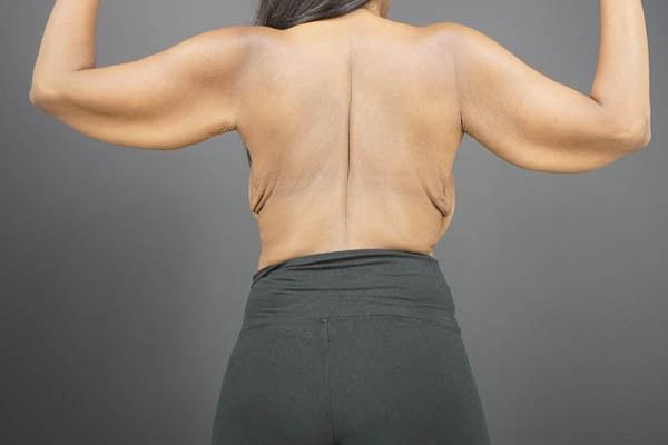 Arm Lift before at Élevé Plastic & Reconstructive Surgery (Olatomide (Tomi) Familusi, MD) in Atlanta, GA