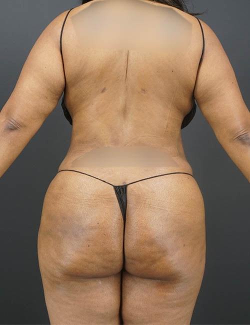 Élevé Plastic & Reconstructive Surgery (Olatomide (Tomi) Familusi, MD) liposuction after — Atlanta, GA