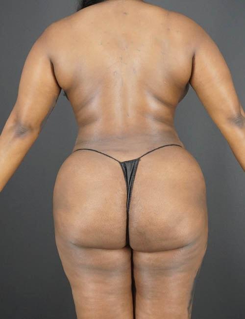 Élevé Plastic & Reconstructive Surgery (Olatomide (Tomi) Familusi, MD) liposuction after — Atlanta, GA