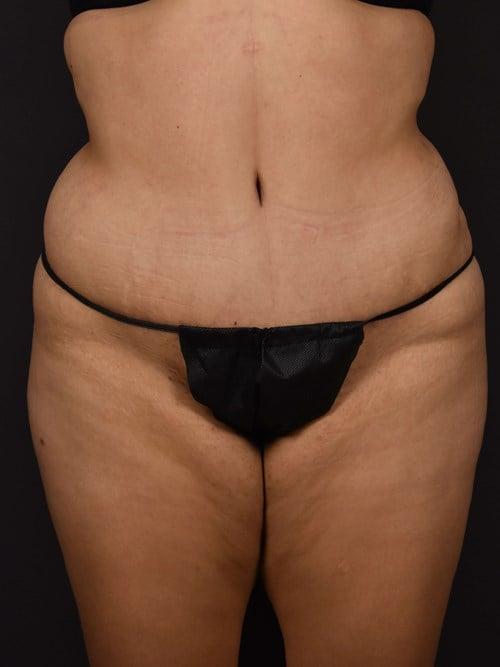 Plastic Surgery Vegas tummy tuck after — Las Vegas, NV