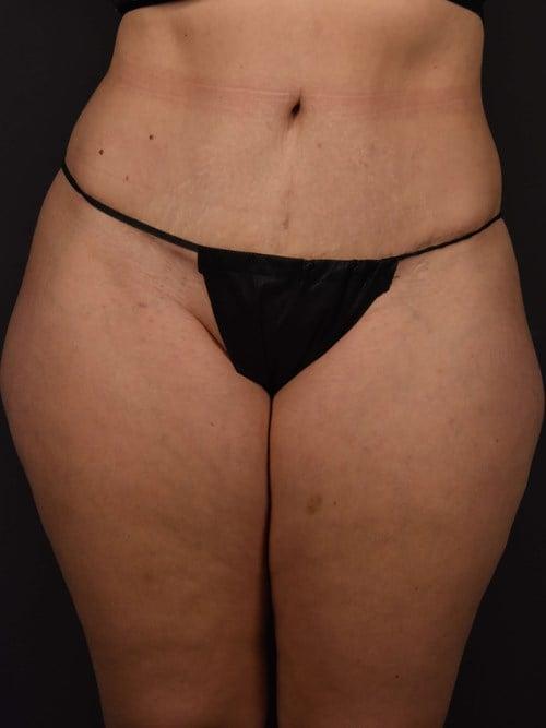 Tummy Tuck after at Plastic Surgery Vegas in Las Vegas, NV