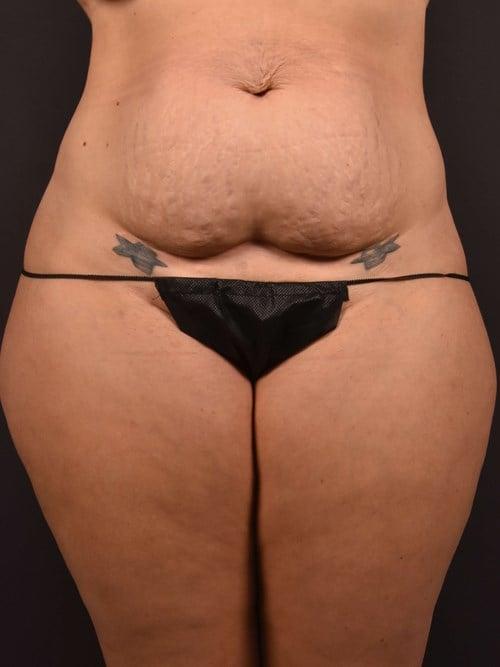 Tummy Tuck before at Plastic Surgery Vegas in Las Vegas, NV