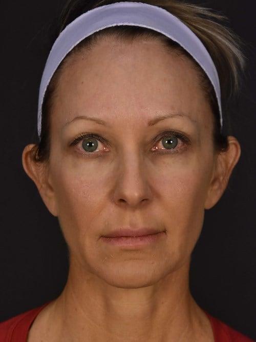 Facelift before at Plastic Surgery Vegas in Las Vegas, NV