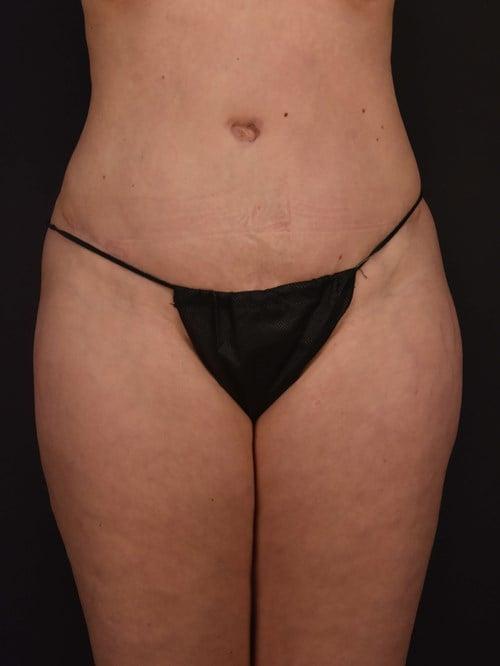 Plastic Surgery Vegas tummy tuck after — Las Vegas, NV