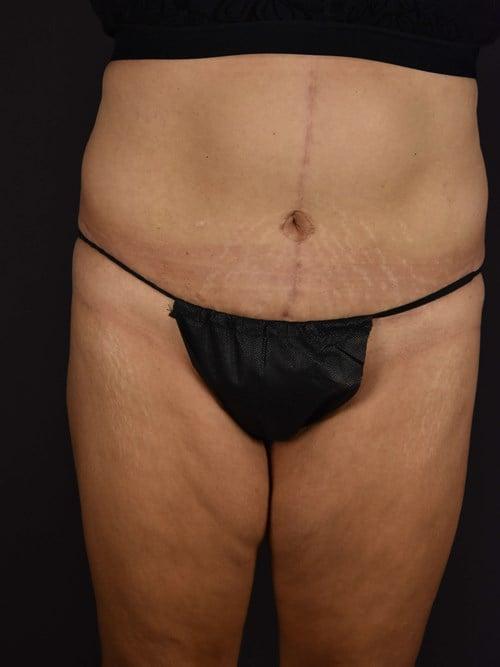 Tummy Tuck after at Plastic Surgery Vegas in Las Vegas, NV