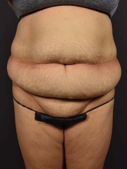 Tummy Tuck before at Plastic Surgery Vegas in Las Vegas, NV