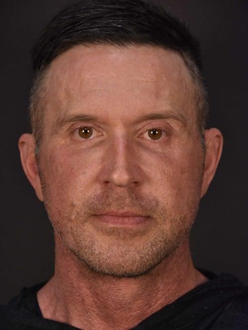 Facelift after at Plastic Surgery Vegas in Las Vegas, NV