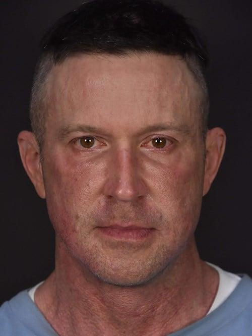 Facelift before at Plastic Surgery Vegas in Las Vegas, NV
