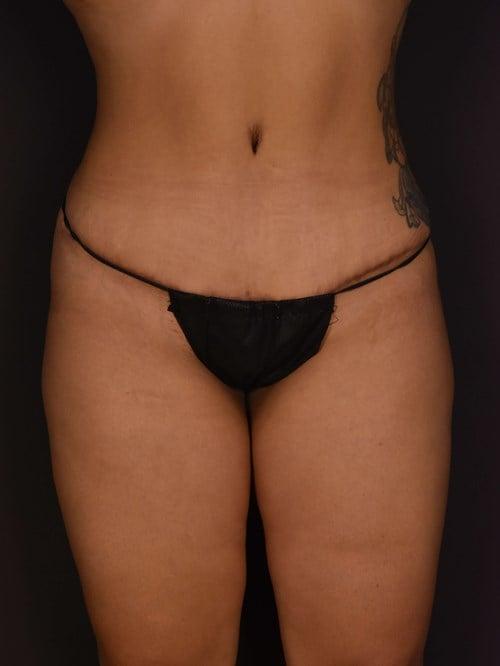 Plastic Surgery Vegas tummy tuck after — Las Vegas, NV