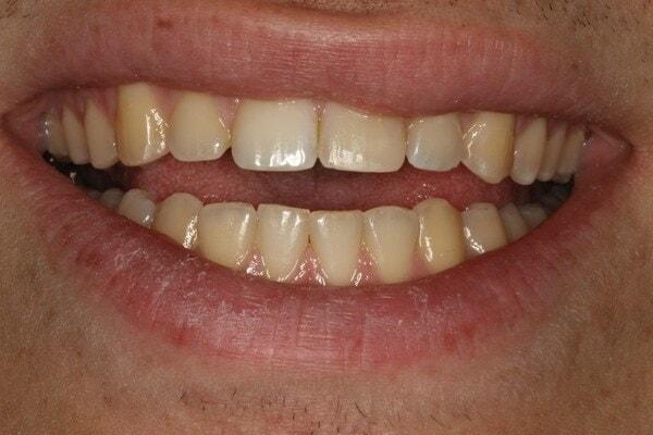 The Sugar House Dentist dental bonding after — Salt Lake City, UT
