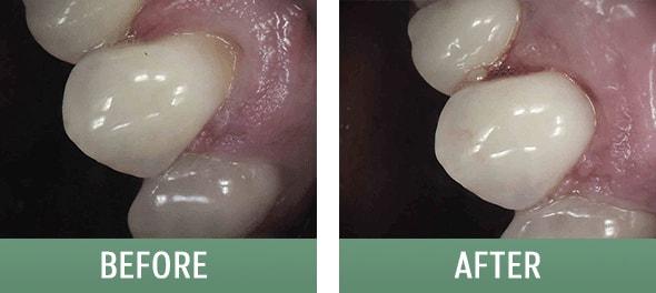 The Sugar House Dentist gum reshaping result — Salt Lake City, UT