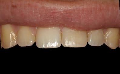 The Sugar House Dentist dental bonding after — Salt Lake City, UT