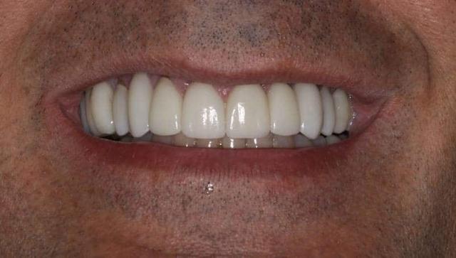 Smile Makeover after at The Sugar House Dentist in Salt Lake City, UT