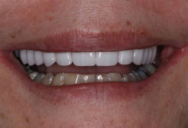 Dental Veneers after at The Sugar House Dentist in Salt Lake City, UT
