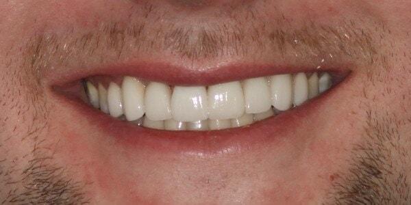 The Sugar House Dentist veneers after — Salt Lake City, UT