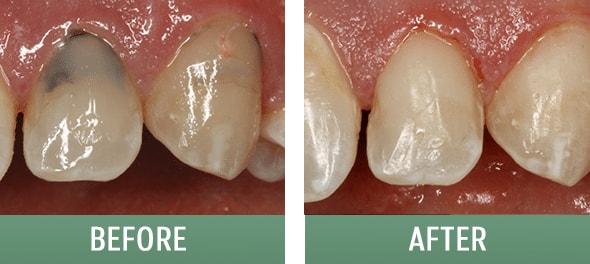 The Sugar House Dentist dental bonding result — Salt Lake City, UT