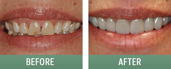 The Sugar House Dentist smile makeover result — Salt Lake City, UT