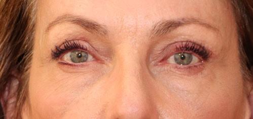 Raj Dedhia, MD eyelid lift after — San Francisco, CA