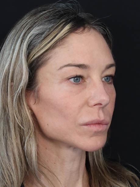 Raj Dedhia, MD facelift after — San Francisco, CA
