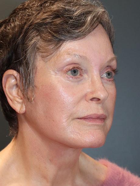 Raj Dedhia, MD facelift after — San Francisco, CA