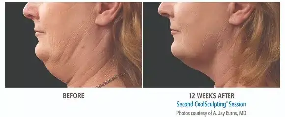 CoolSculpting result at Bella Medspa in Philadelphia, PA