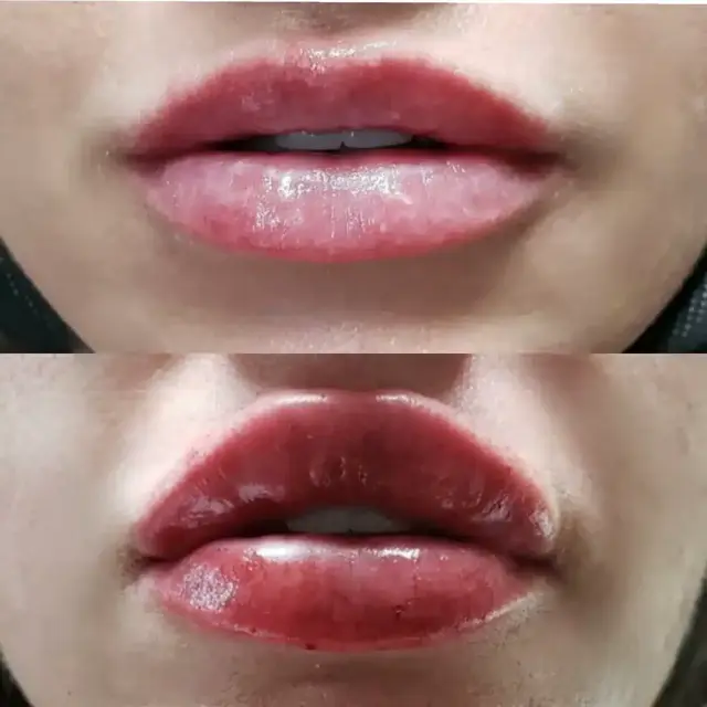 Lip Filler result at Bella Medspa in Philadelphia, PA