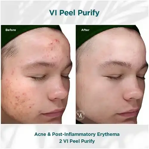 Chemical Peel result at Bella Medspa in Philadelphia, PA