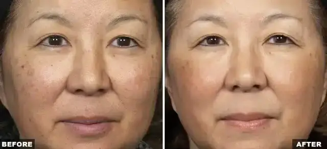 Laser Skin Resurfacing result at Bella Medspa in Philadelphia, PA
