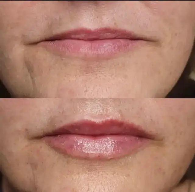 Lip Filler result at Bella Medspa in Philadelphia, PA