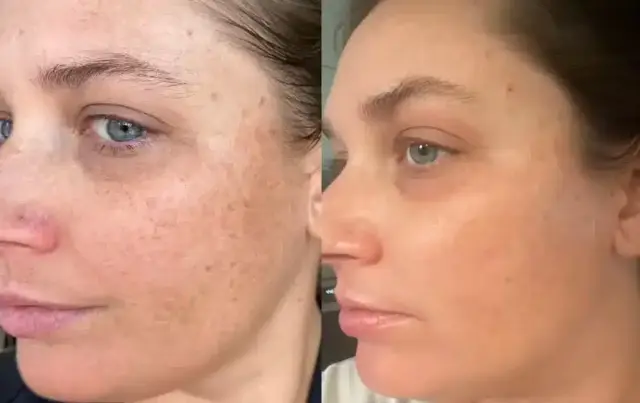 Laser Skin Resurfacing result at Bella Medspa in Philadelphia, PA